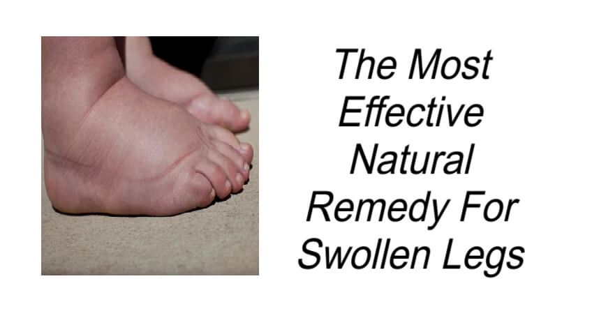 Natural Remedy For Swollen Legs