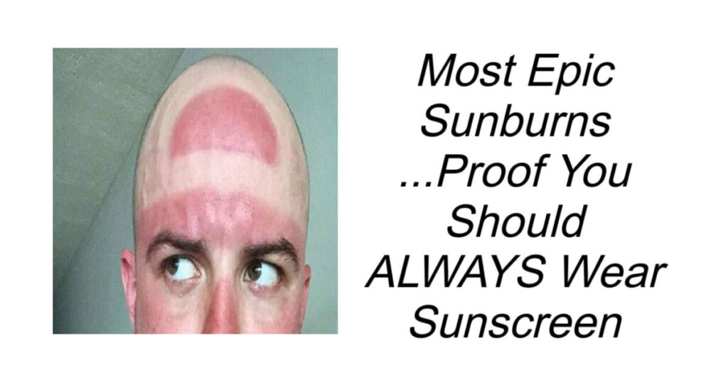 Most Epic Sunburns