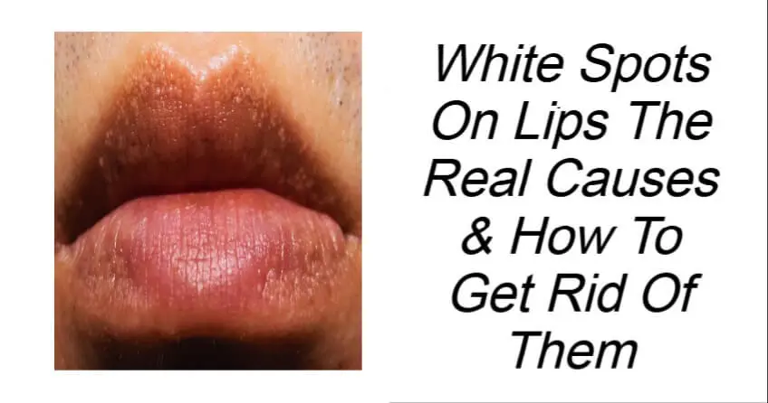 White Spots On Lips The Real Causes