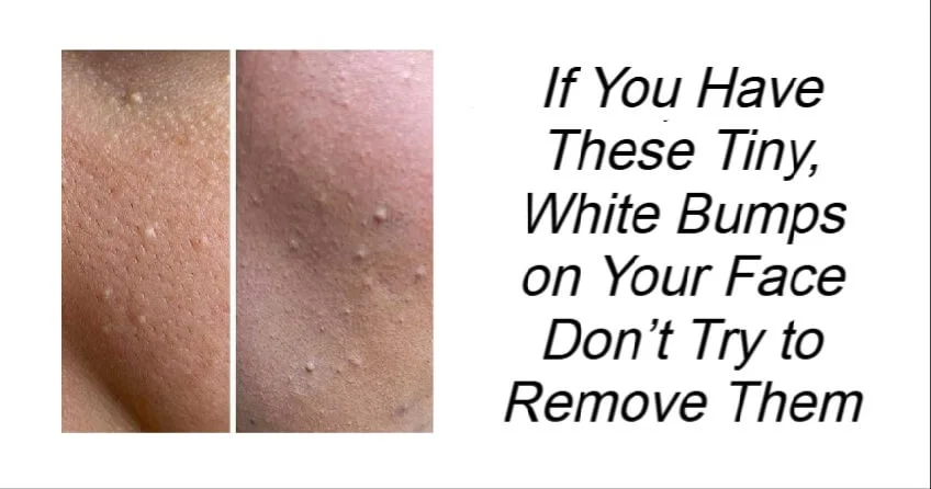 White Bumps on Your Face Don’t Try to Remove Them