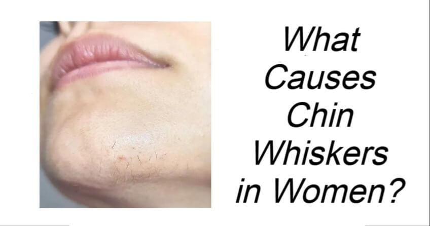 Chin Whiskers in Women