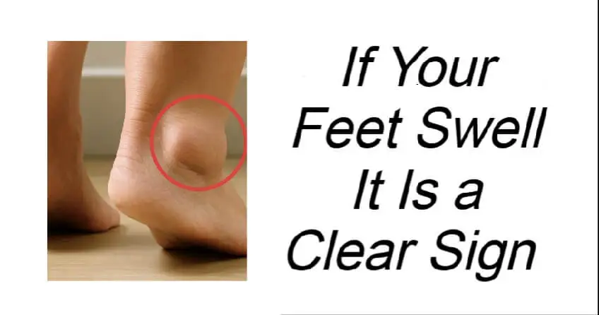 If Your Feet Swell It Is a Clear Sign 