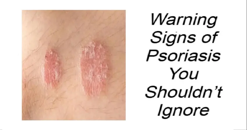 Warning Signs of Psoriasis You Shouldn’t Ignore