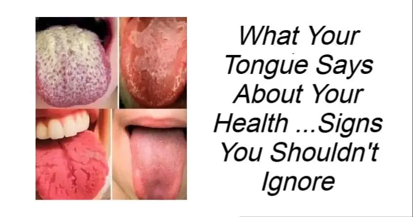 What Your Tongue Says About Your Health