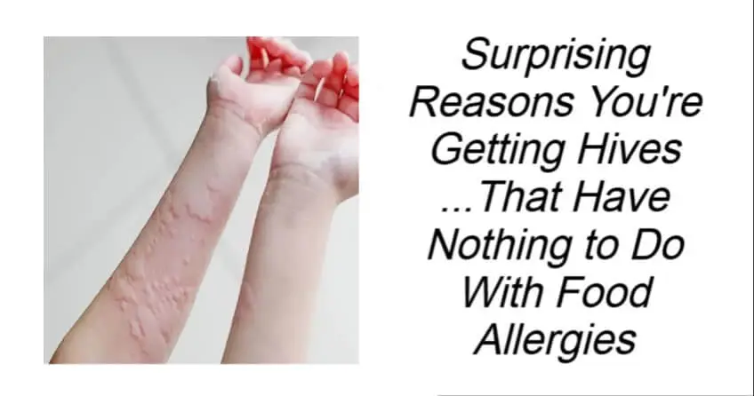 Surprising Reasons You're Getting Hives