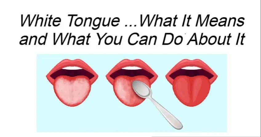 White Tongue