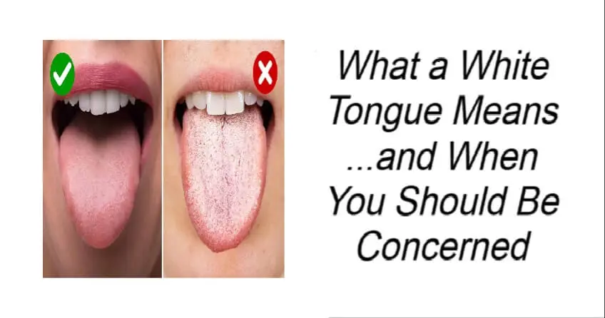 What a White Tongue Means