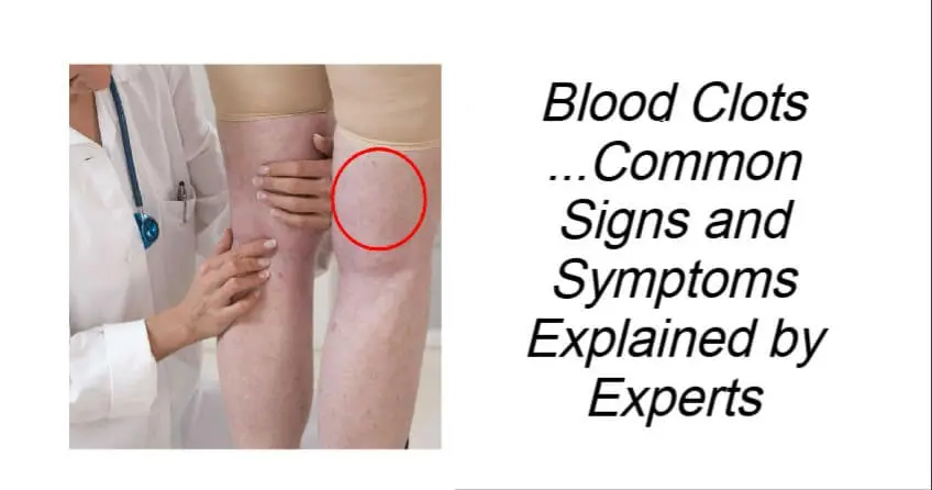 Blood Clots