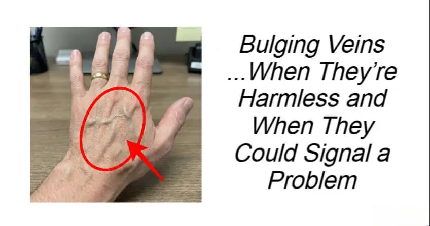 Bulging Veins