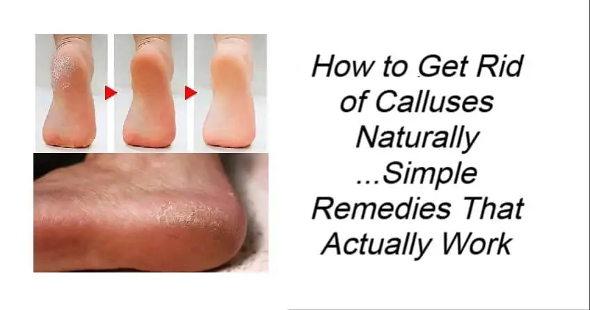 How to Get Rid of Calluses Naturally