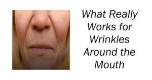 What Really Works for Wrinkles Around the Mouth