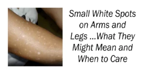 Small White Spots on Arms and Legs