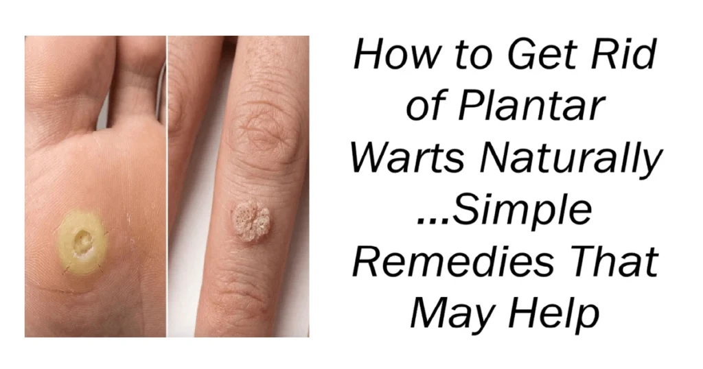 How to Get Rid of Plantar Warts Naturally