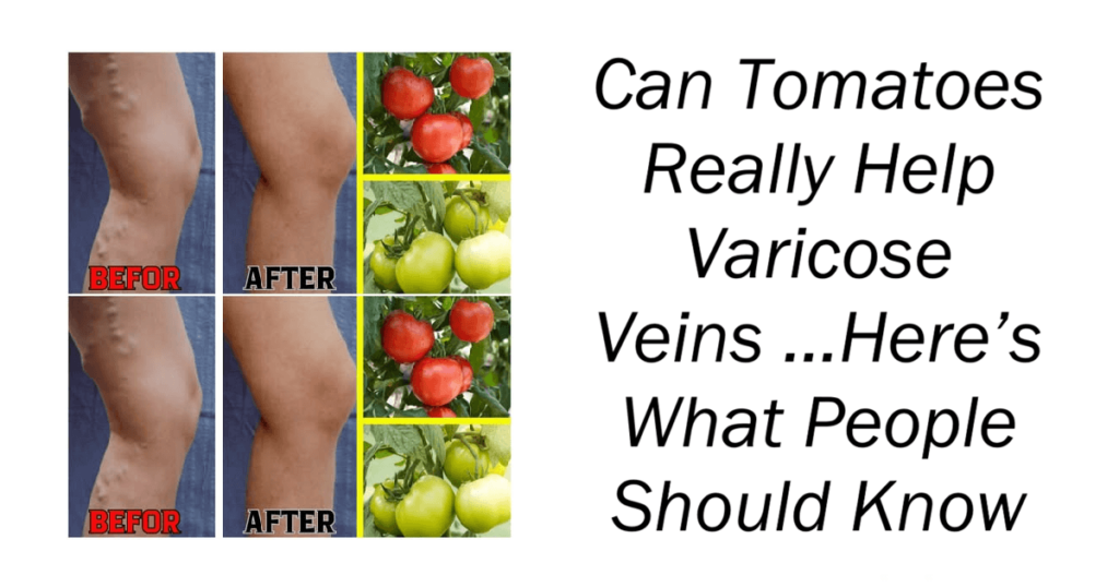 Can Tomatoes Really Help Varicose Veins