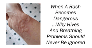 When A Rash Becomes Dangerous