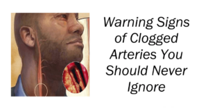 Warning Signs of Clogged Arteries