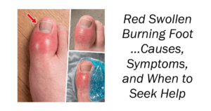 Red Swollen Burning Foot
