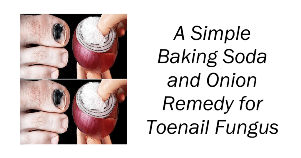 Remedy for Toenail Fungus