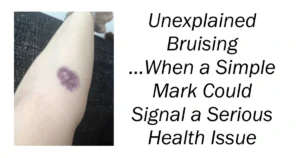 Unexplained Bruising