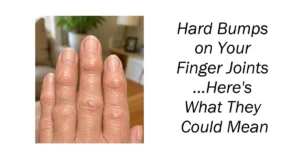 Hard Bumps on Your Finger Joints