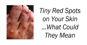 Tiny Red Spots on Your Skin