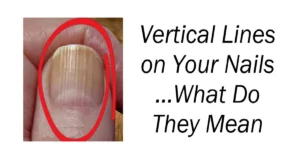 Vertical Lines on Your Nails