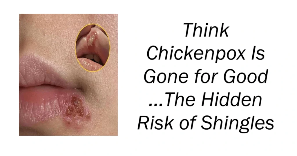Think Chickenpox Is Gone for Good