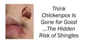 Think Chickenpox Is Gone for Good